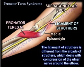 Pronator Syndrome