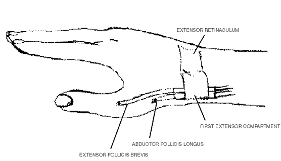 De Quervain’s Tenosynovitis – Bondi Junction Hand Therapy